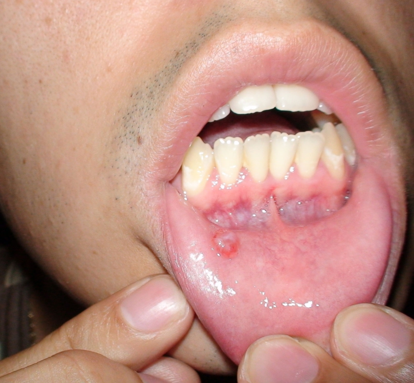 Mouth Lip 22